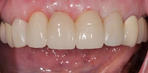 after dental implant