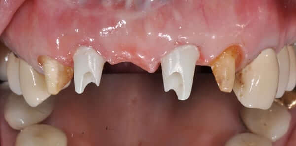 before dental implant