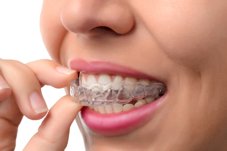 Closeup of a woman taking out her Invisalign aligners to clean them