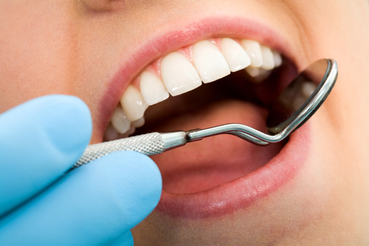 Closeup of a woman's mouth with a metal dental instrument examining her teeth for tooth decay